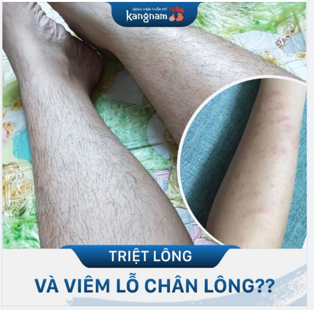 Triệt lông bị viêm lỗ chân lông có điều trị được không?
