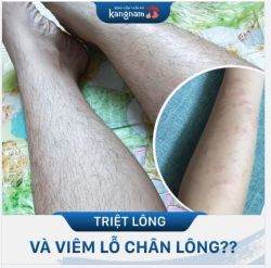 VIÊM LỖ CHÂN LÔNG sau TRIỆT LÔNG, lý do tại sao?