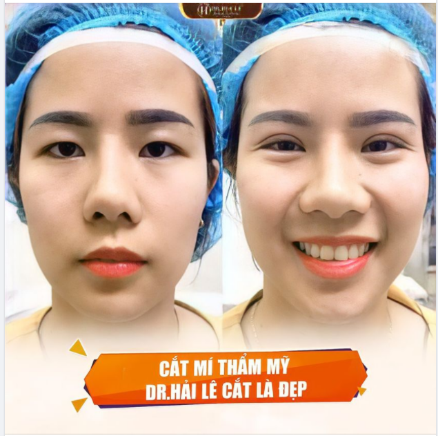VTM Y KHOA DR.HẢI LÊ - ĐỊA CHỈ CẮT MÍ UY TÍN, CHẤT LƯỢNG DÀNH CHO BẠN.!!