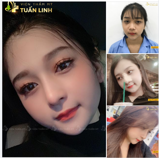 XINH ĐẸP QUÁ ! Chỉ nhờ nâng mũi cấu trúc thôi đó ạ.