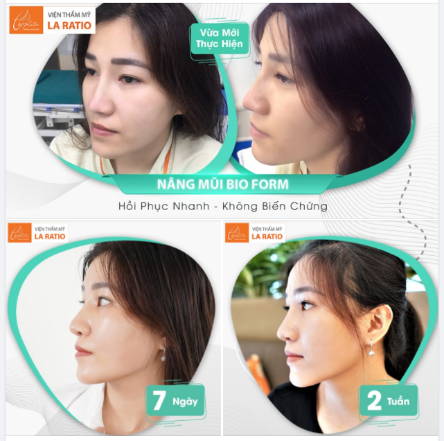 XINH ĐẸP RẠNG NGỜI HƠN SAU KHI NÂNG MŨI CHỈ MỚI 2 TUẦN