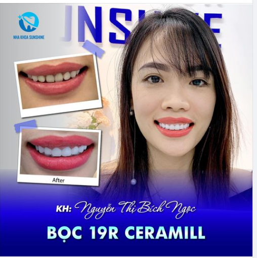 Xinh đẹp rạng rỡ hơn cùng chị Bích Ngọc với 19 răng sứ Ceramill