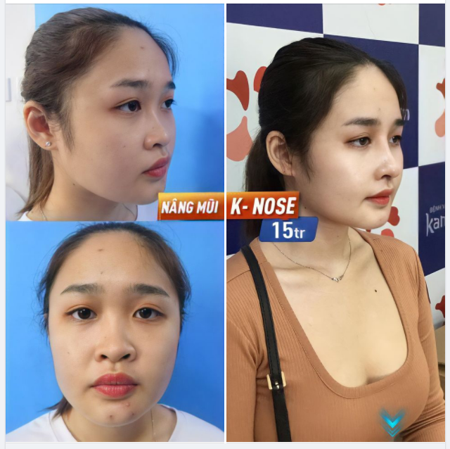 Xinh sang hết sức sau NÂNG MŨI K-NOSE