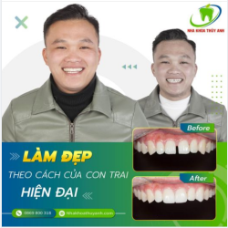 XÓA BỎ KHE THƯA - BỪNG SÁNG CẢ KHUÔN MẶT