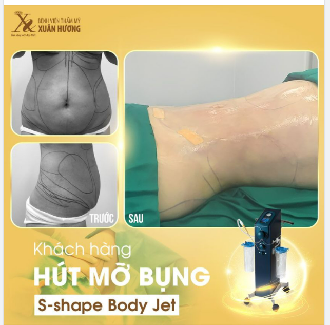 XÓA BỎ MỌI MẶC CẢM TỰ TI VỀ VÒNG 2 NGẤN MỠ