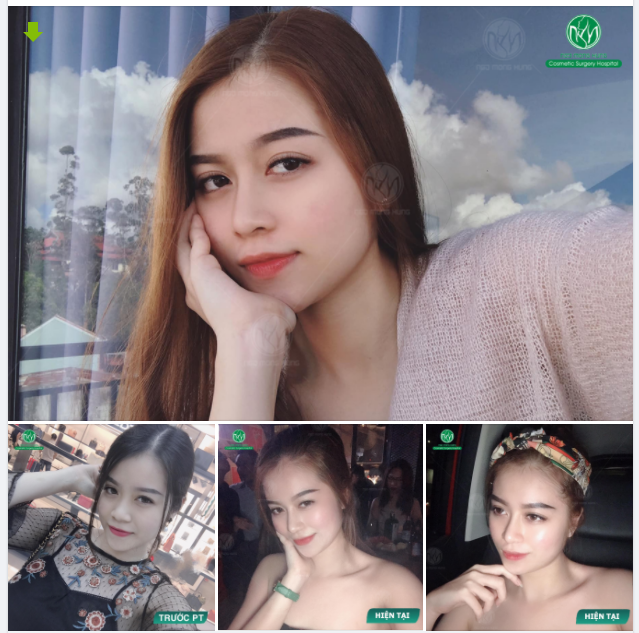 XÓA KHUYẾT ĐIỂM - SỞ HỮU DÁNG MŨI CỰC XINH