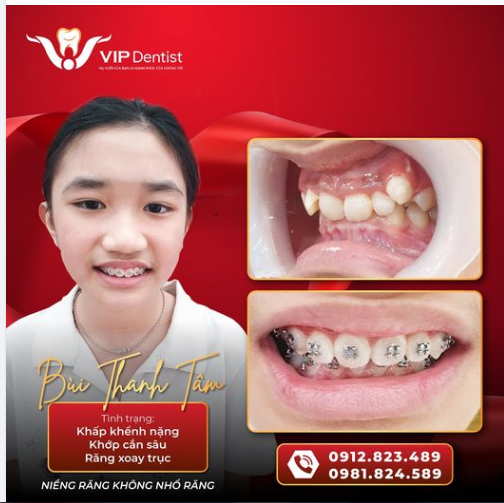 XÓA KÍ ỨC VỀ HÀM RĂNG CŨ KÉM DUYÊN