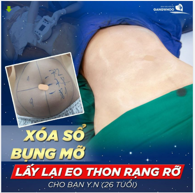 XÓA SỔ BỤNG MỠ LẤY LẠI EO THON RỰC RỠ CHO BẠN Y.N (26 TUỔI)