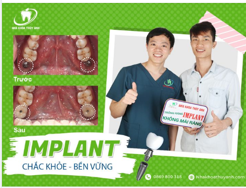 YÊN TÂM ĂN NHAI HƠN KHI TRỒNG RĂNG IMPLANT