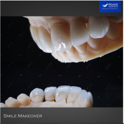 YẾU TỐ NÀO QUYẾT ĐỊNH ĐẾN GIÁ THÀNH RĂNG SỨ