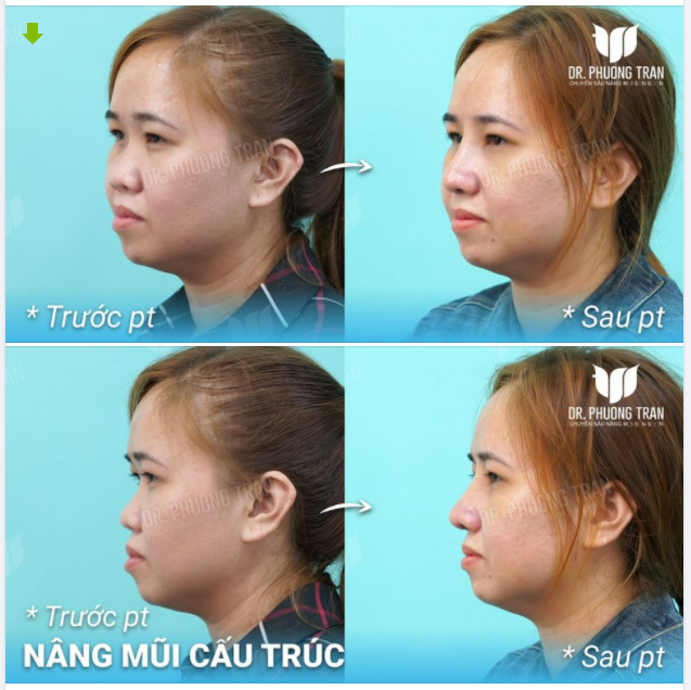 1,2,3 ÚM BA LA MŨI HẾT GÃY