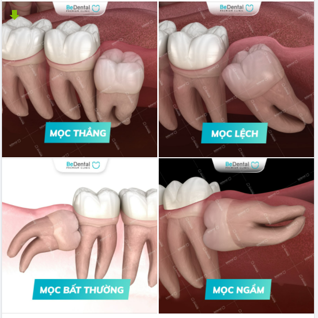 15 phút tạm biệt mọi thế khó của răng khôn