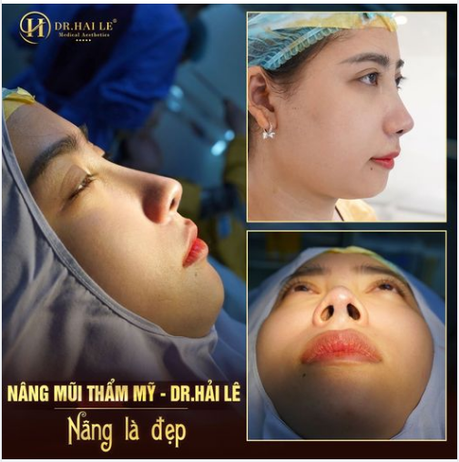 1H  có ngay dáng mũi sang chảnh triệu like bạn có muốn?