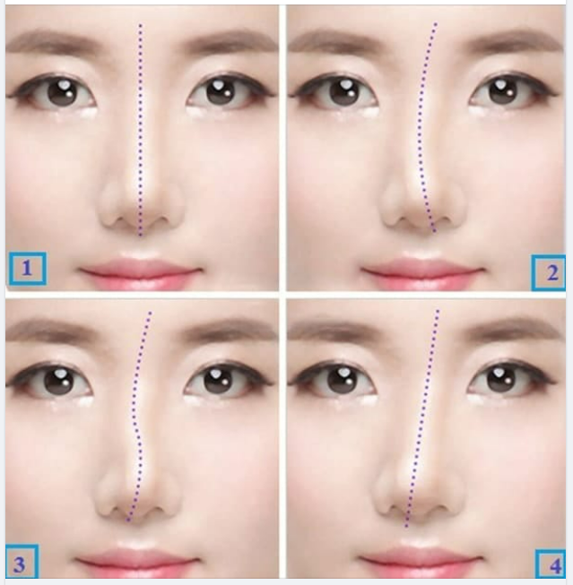 3 NGUYÊN NHÂN KHIẾN MŨI BỊ LỆCH SAU KHI NÂNG
