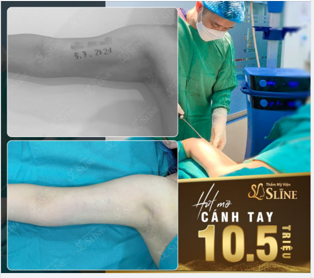 30 PHÚT "DIỆT" MỠ - TAY THON "HẾT CỠ"