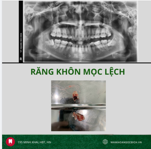 30 PHÚT - LOẠI BỎ NGAY RĂNG KHÔN MỌC LỆCH