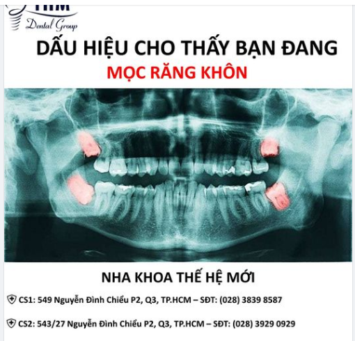 4 DẤU HIỆU MỌC RĂNG KHÔN DỄ NHẬN BIẾT NHẤT