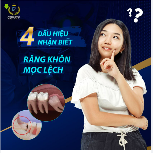 4 dấu hiệu nhận biết răng khôn mọc lệch