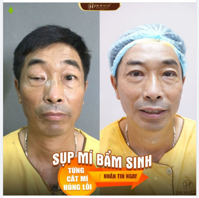 47 năm sống chung với đôi mắt lệch to nhỏ, tầm nhìn bị che khuất bởi sụp mí vị khách hàng vỡ òa xúc động vì sau từng ấy năm mới có được cảm giác mắt nhắm mở như bình thường!!!