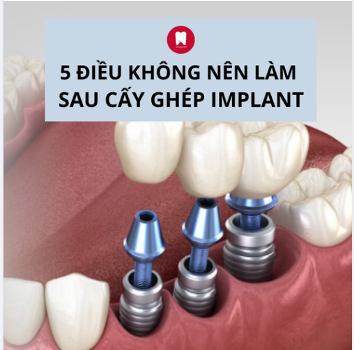 5 ĐIỀU KHÔNG NÊN LÀM SAU CẤY GHÉP IMPLANT
