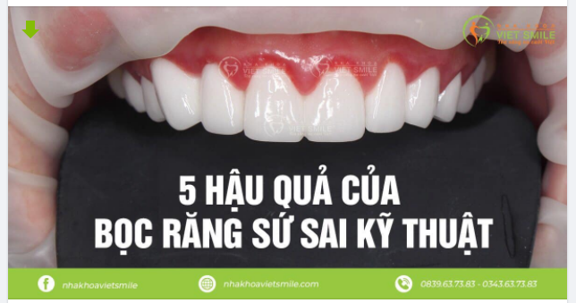 5 HẬU QUẢ TAI HẠI KHI SỬ DỤNG RĂNG SỨ GIÁ RẺ