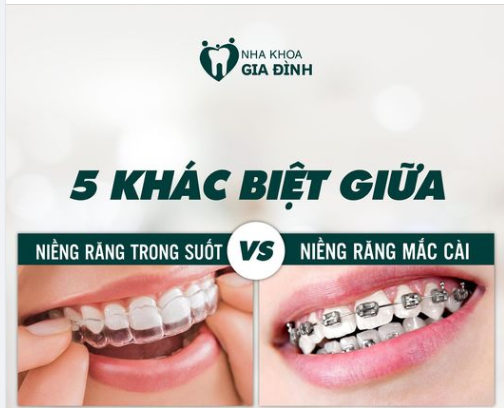 5 KHÁC BIỆT GIỮA NIỀNG RĂNG TRONG SUỐT VÀ MẮC CÀI