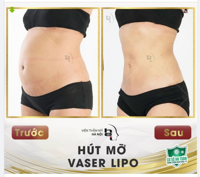 5 NĂM GIẢM BÉO KHÔNG BẰNG 45 PHÚT HÚT MỠ VASER LIPO