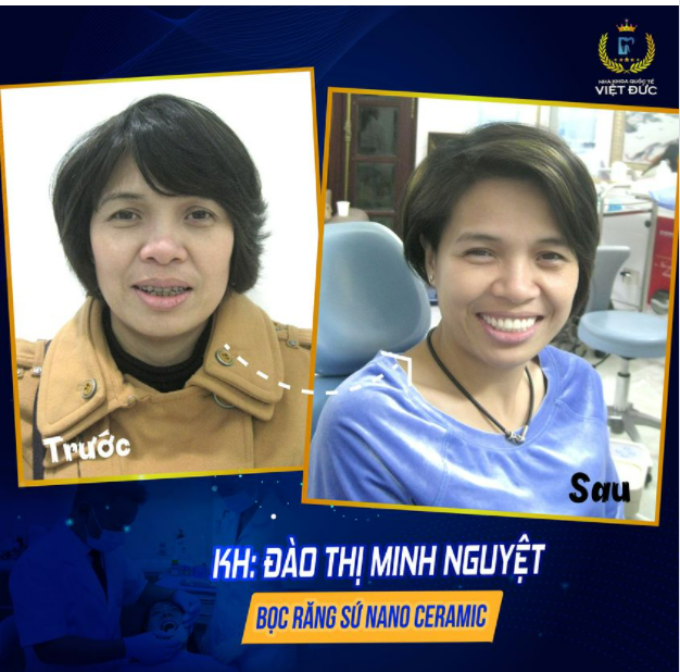 50 năm chịu cảnh răng xấu, thay đổi 180 độ sau thẩm mỹ răng sứ