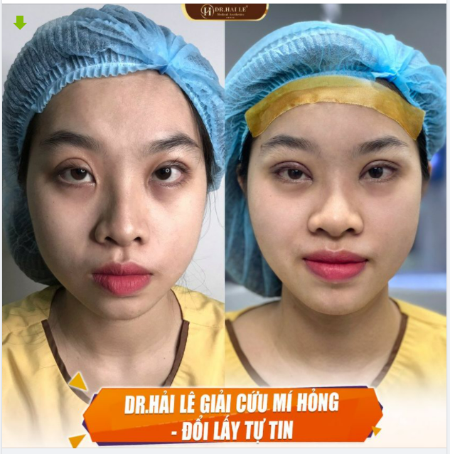 6 LÝ DO LỰA CHỌN SỬA MÍ HỎNG TẠI DR.HẢI LÊ