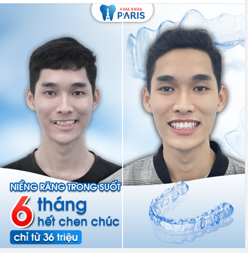 6 tháng - Răng hết xô lệch - Tiết kiệm chi phí