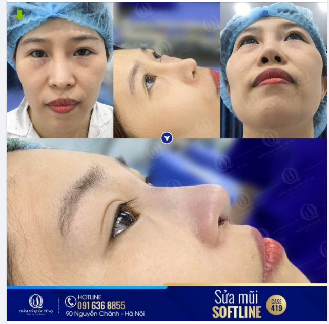 60 PHÚT “GIẢI THOÁT” CHO MŨI LỆCH SỐNG.