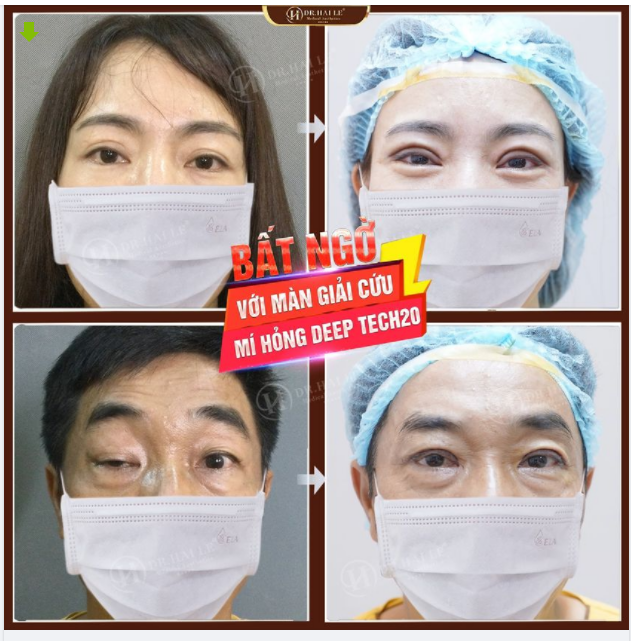 Ai còn lăn tăn công nghệ sửa mí Dr.Hải Lê thì cứ tự tin đi ạ ... mí sửa lại mà được hơn 90% là quá tuyệt vời rồi ạ"