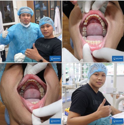 Ai mất răng lâu ngày mới hiểu được cái khó mỗi khi ăn nhai cảm giác bị hụt, mỗi khi đánh răng lại phải lựa cho sạch sẽ sợ viêm lợi, mỗi khi cười dù răng hàm chẳng lộ ra nhưng cũng vẫn thấy ngại ngùng,