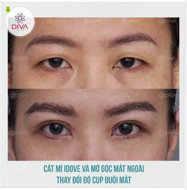 AI NÊN MỞ RỘNG GÓC MẮT NGOÀI?