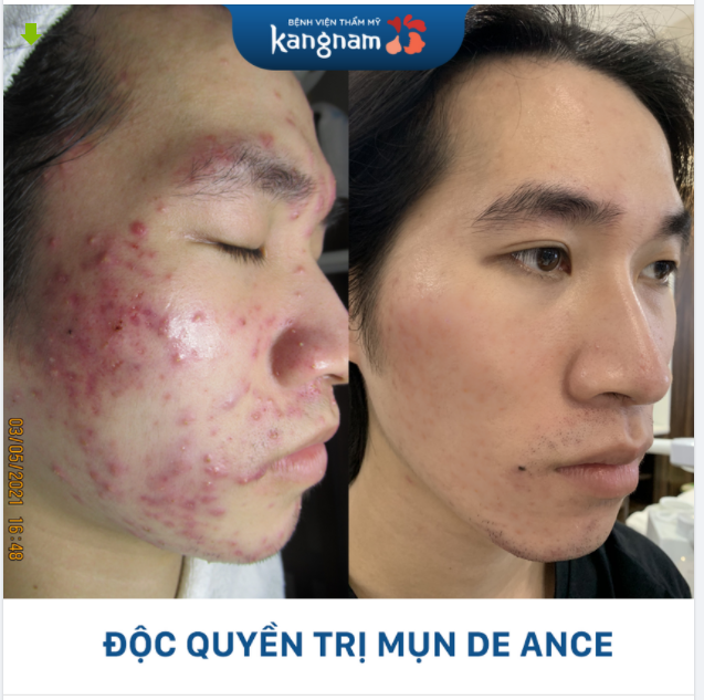 AI RỒI CŨNG HẾT MỤN THÔI Nếu chọn ĐÚNG PHƯƠNG PHÁP?