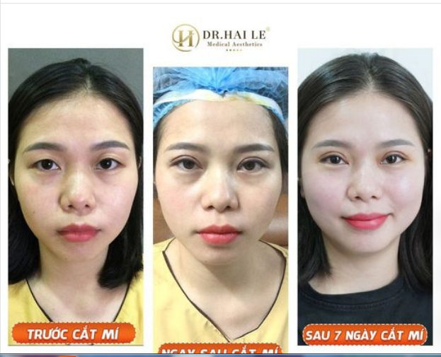 Ai xui Mắt đẹp - Mí xinh