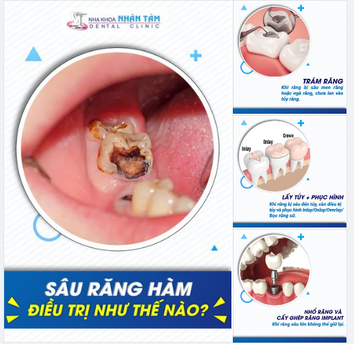 Alo Nha sĩ: Bác sĩ cho hỏi răng hàm bị sâu đã lan rộng tới tủy thì có trám lại được không hay cần nhổ bỏ ạ?