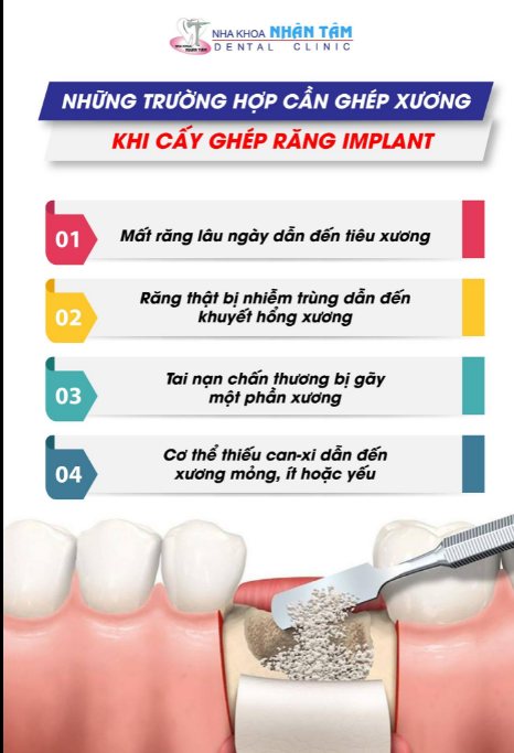 Alo Nha sĩ: Bác sĩ ơi, có phải trường hợp nào cũng cần ghép xương khi trồng răng Implant không Bác sĩ?