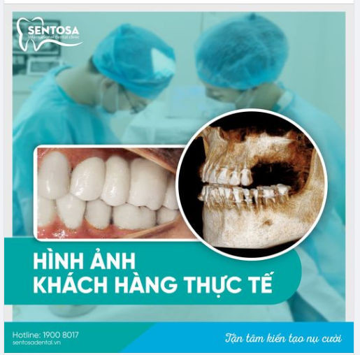 Ăn ngon hơn – Cười đẹp hơn – Không còn sợ răng bị chuyển….