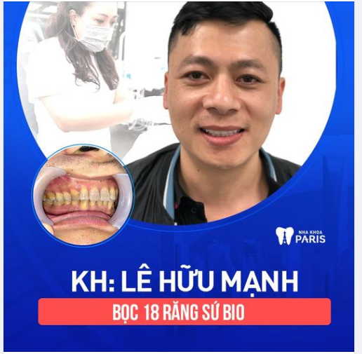 Anh Lê Hữu Mạnh (Hà Nội) đến với Nha khoa Paris với mong muốn thay áo mới cho hàm răng xỉn màu, xấu xí.