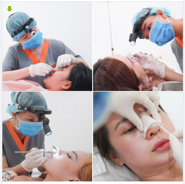 "AZ ơi, em làm mũi 7 ngày rồi mà tự nhiên mũi đau nhức và có sưng đỏ thế này, không biết có làm sao không?"