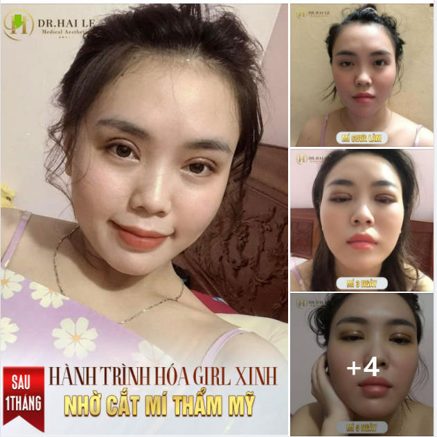 Bấm xem ngay nếu bạn đang đắn đo, muốn tìm hiểu hành trình thay đổi sau khi Cắt mí tại Dr.Hải Lê