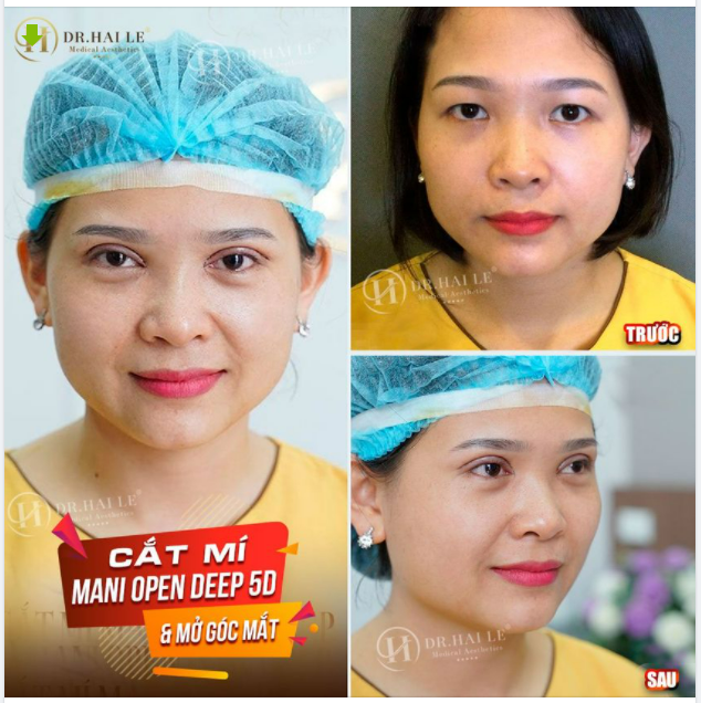 Bạn có biết quy luật 20/80 khi thẩm mỹ mắt tại Dr.Hải Lê?