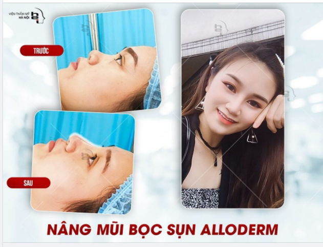 "​​​​​​​Bạn đang mong muốn nâng mũi để có một chiếc mũi cao, đẹp mà không muốn bị người khác nhận ra?