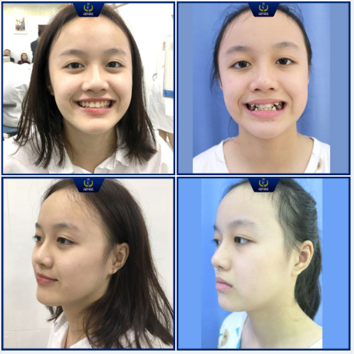 Bạn Hoàng Minh Trang đã lấy lại nụ cười đều đẹp, xóa bỏ hoàn toàn các khuyết điểm: Khấp khểnh, cắn ngược chỉ sau 12 tháng chỉnh nha tại Nha khoa Quốc tế Việt Đức.