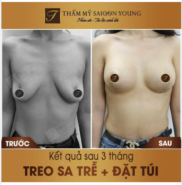 Bạn khách hàng tái khám sau 3th treo sa trễ và kết hợp đặt túi: