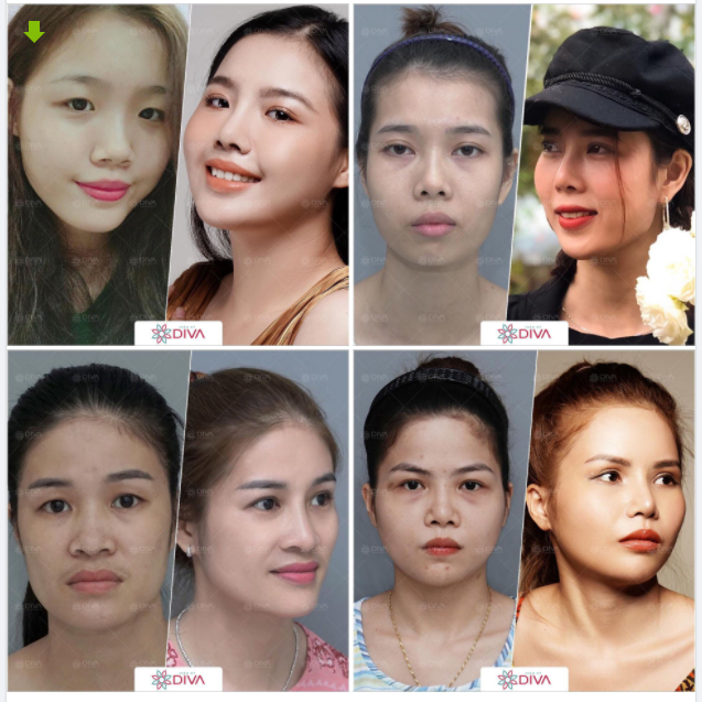 BẤT CỨ AI CŨNG CÓ THỂ BIẾN HÓA XINH ĐẸP, ẤN TƯỢNG SAU NÂNG MŨI