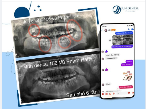 BẤT NGỜ ĐI NIỀNG RĂNG VÀ PHÁT HIỆN RA 4 RĂNG KHÔN VÀ 3 RĂNG NGẦM