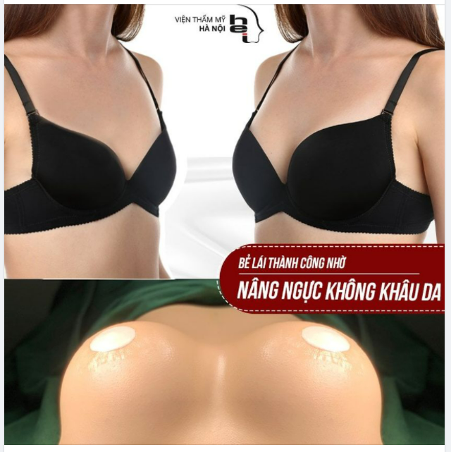 BẺ LÁI THÀNH CÔNG NHỜ NÂNG NGỰC KHÔNG KHÂU DA
