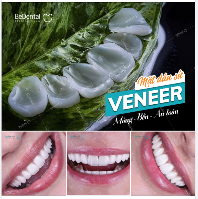 BEDENTAL KIẾN TẠO NỤ BỞI MẶT DÁN SỨ VENEER